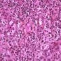 Acute inflammation with granulocytic diapedesis in ileal Crohn (...)