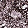 Nodal cryptococcosis (Cryptococcus neoformans)