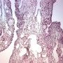 Pleuropulmonary blastoma type 1