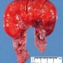 Intestinal infarction by volvulus