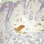 Negative SMA immunostaining in dermatofibrosarcoma protuberans