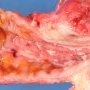 Cobblestone appearance in Crohn ileitis