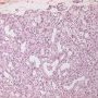 Infantile hemangioma