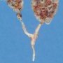 Bilateral multicystic kidneys