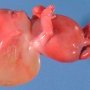 Cystic hygroma