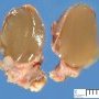 Thyroglossal tract cyst