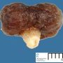 Colonic juvenile polyp