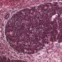Blastemal component in Wilms tumor