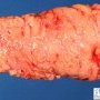 Mature lipoma