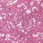 Acute pneumonia in bacterial pneumonia