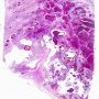 Telangiectatic osteosarcoma