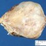 Osteochondroma
