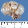 Osteochondroma
