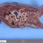 Pulmonary arteriovenous malformation in Hereditary hemorrhagic (...)