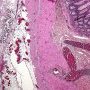 Subserosal calcification
