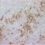 Thymic seminoma (PLAP)