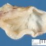 Mediastinal esophageal duplication cyst (primitive foregut cyst)