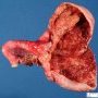 Ovarian luteal cyst