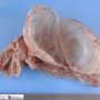 Mesenteric cystic lymphangioma