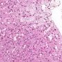 Niemann-Pick disease type B (NPB)