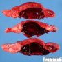 A frequent cause of fetal death: retroplacental hematoma