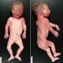Low hair implantation in malformative syndrome