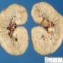 Autosomal recessive polycystic kidney disease (ARPKD) in a neonate (1 (...)