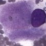 Gaucher cell in bone marrow cytology