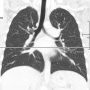 Axilary synovial sarcoma