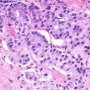 Gleason Pattern 4 (WebPathology)