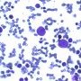 Parvovirus B19 cytopathogenic effect in bone marrow