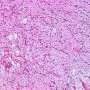 Myxoid liposarcoma