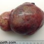 Thymoma, type A