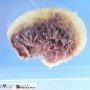 Osteochondroma