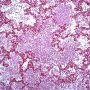 Acute pneumonia in bacterial pneumonia