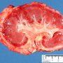 Acute renal allograft rejection
