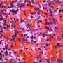 Cutaneous leishmaniasis