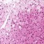 Niemann-Pick disease type B (NPB)