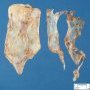Ovarian cystic juvenile granulosa tumor