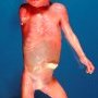 Humeral meromelia (fetus, 21 weeks)