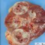 Leiomyomatous renal cell carcinoma