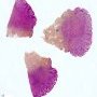 Spitz nevus