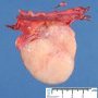 Gonadoblastoma and dysgerminoma in gonadal dysgenesis