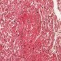 Focal myocardial infarction in thrombotic microangiopathy