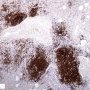 Pulmonary nodular lymphoid hyperplasia