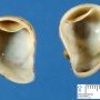 Intestinal duplication cyst