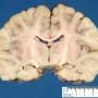 Brain frontal sections