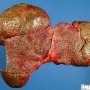 Atrophic cirrhosis in extrahepatic biliary tract atresia