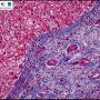 Portal lipid-laden macrophages in CESD-Wolman disease