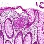 Granulomatous colitis in Crohn disease